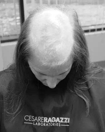  solutions photo gallery womens hair loss crlab 03 womens thinning hair loss system restoration european crlab cnc 02