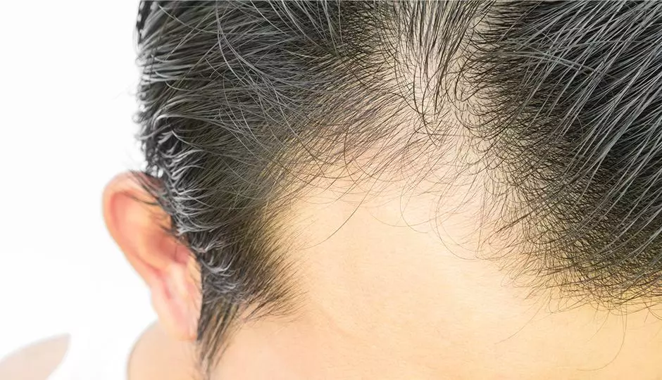 DHT And It&#039;s Role In Hair Loss