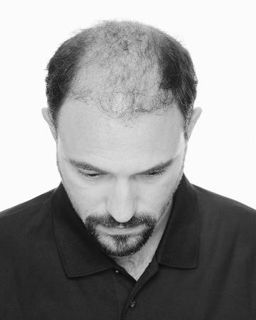 03 mens hair replacement virtual reality 02 solutions photo gallery mens hair loss american hairlines virtual reality 03 mens hair replacement virtual reality 02