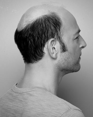 10 mens hair replacement virtual reality 02 solutions photo gallery mens hair loss american hairlines virtual reality 10 mens hair replacement virtual reality 02