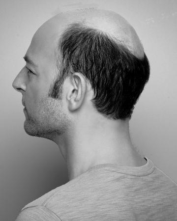 13 mens hair replacement virtual reality 02 solutions photo gallery mens hair loss american hairlines virtual reality 13 mens hair replacement virtual reality 02